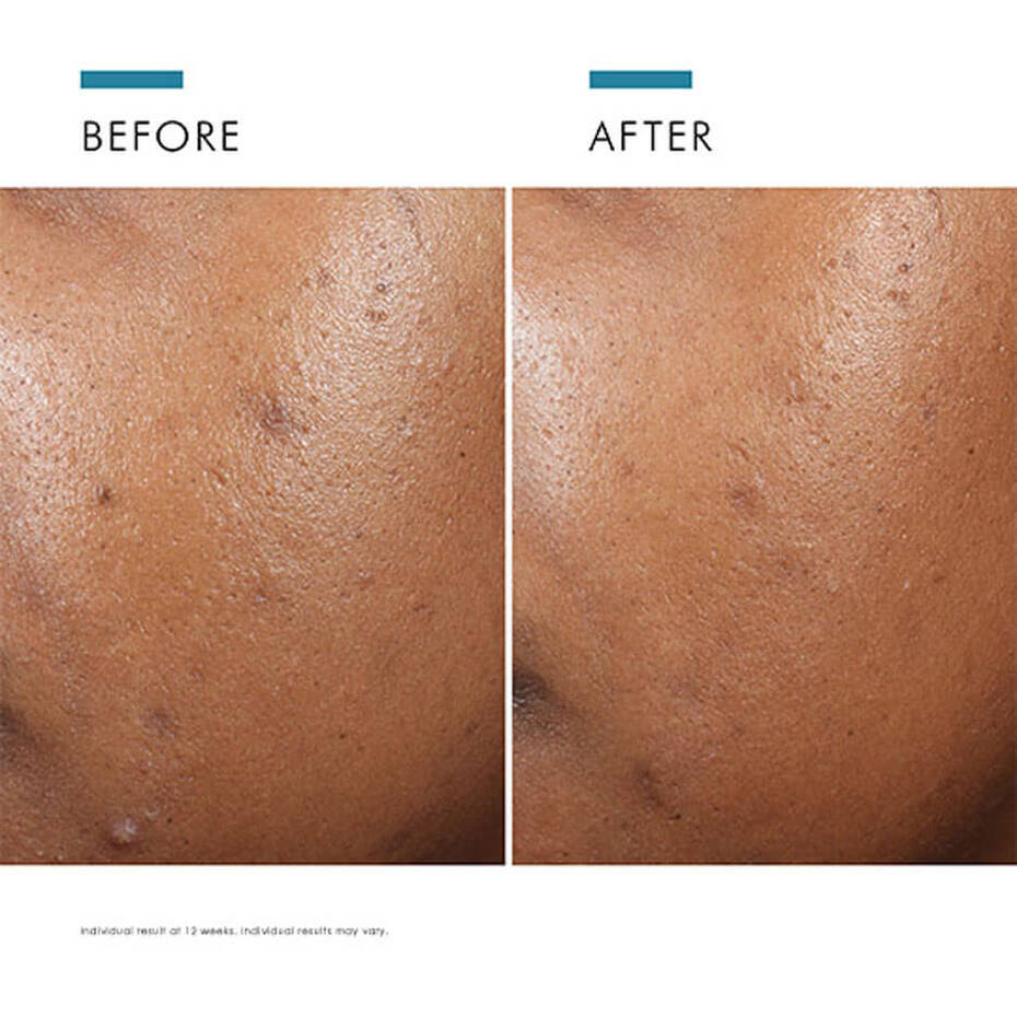 Photo A+ Brightening Treatment 3% Azelaic Acid Moisturizer
