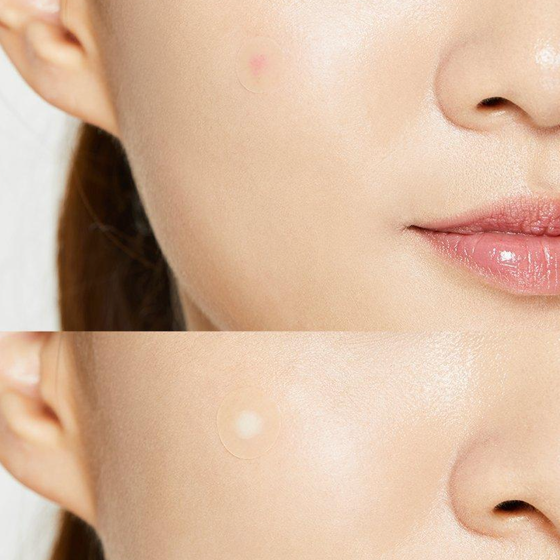 Acne Pimple Master Patch